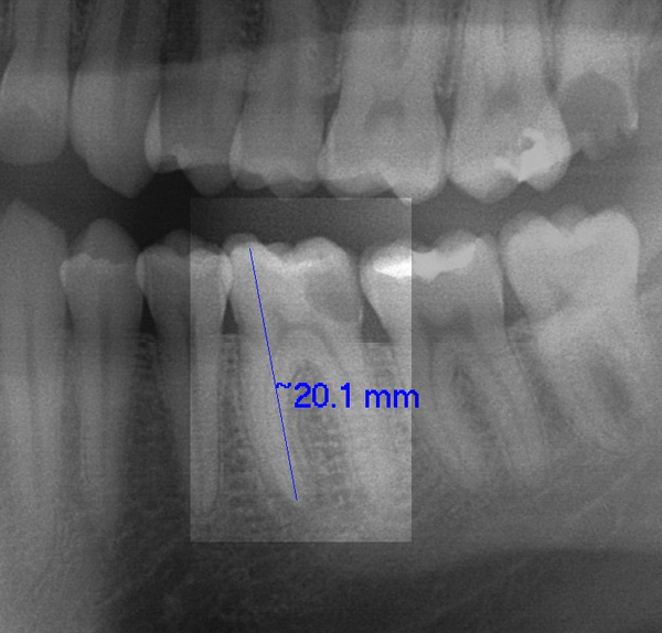 Endo-OPG-w